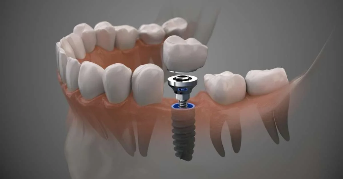 Implantes dentários