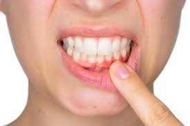 Carie-dental