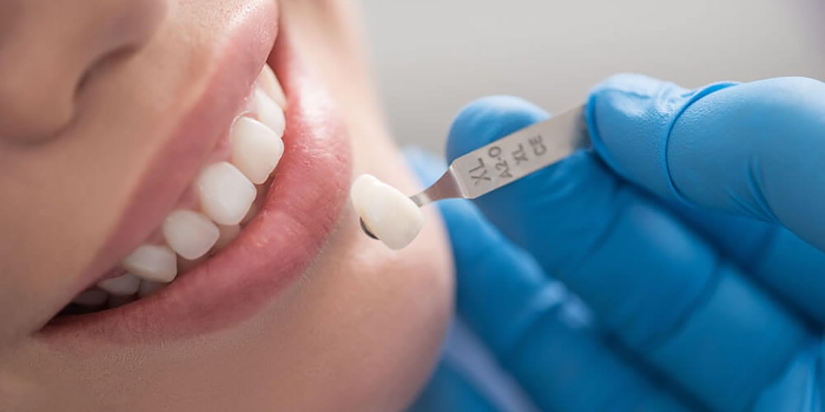 Carie-dental
