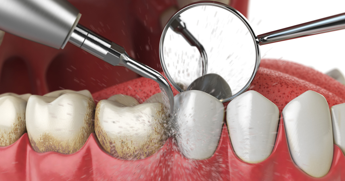 Limpeza-dental